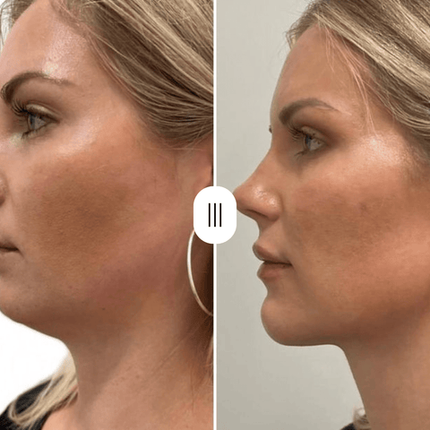 Novani Bear Pro+ microcurrent gezichtsapparaat en Novani Facelift Pro LED beauty device – complete huidverjongingsset voor thuisgebruik