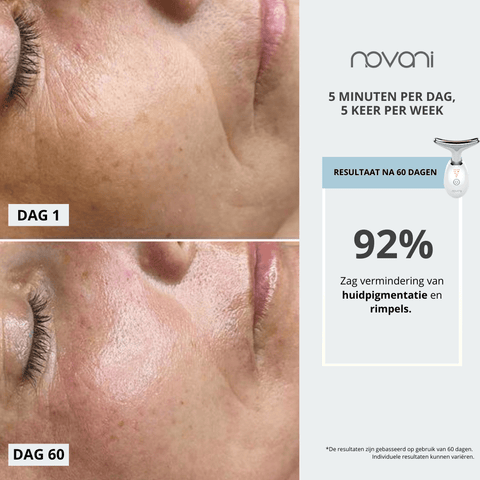 Facelift apparaat voor thuisgebruik – Novani LED beauty device voor glow en V-face