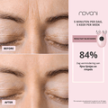 resultaten facelift rimpels
