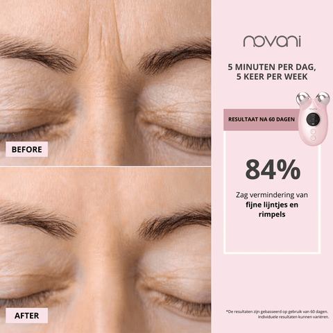 resultaten facelift rimpels
