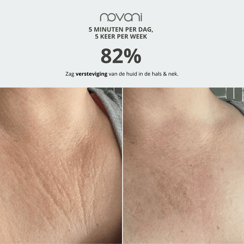 Facelift