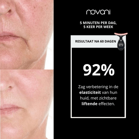 Facelift 